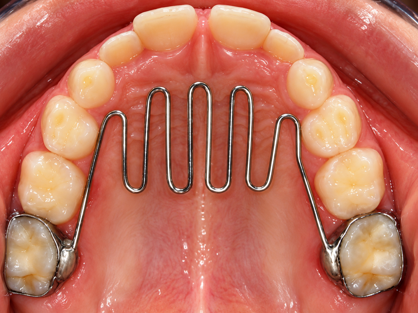 Palatal crib habit-breaking appliance on upper arch